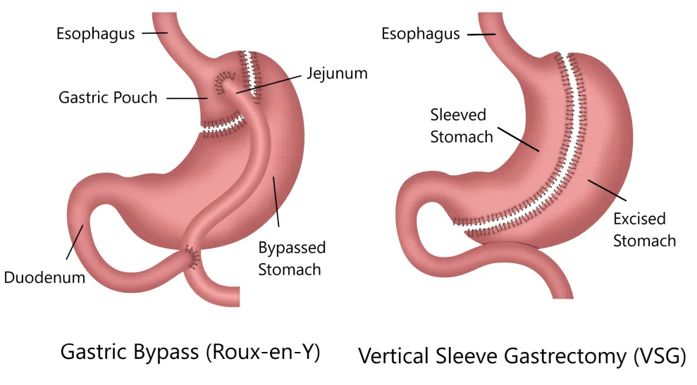 Gastric Bypass vs. Sleeve Gastrectomy: Which One Is Better for You?